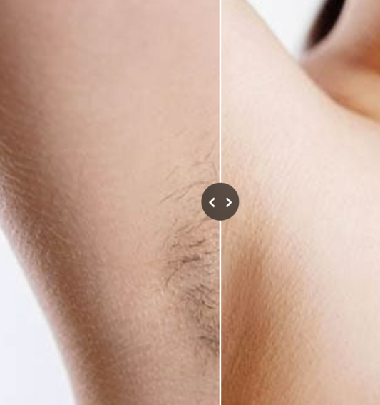 L'épilation IPL démystifiée : réalité et conseils sur la lumière pulsée